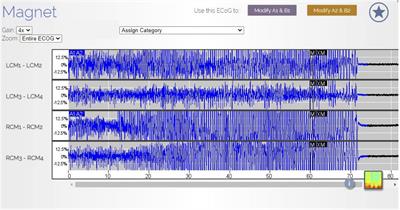 Centromedian thalamic neuromodulation for the treatment of idiopathic generalized epilepsy